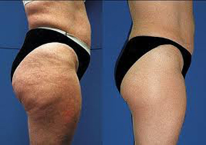 cellulite cream